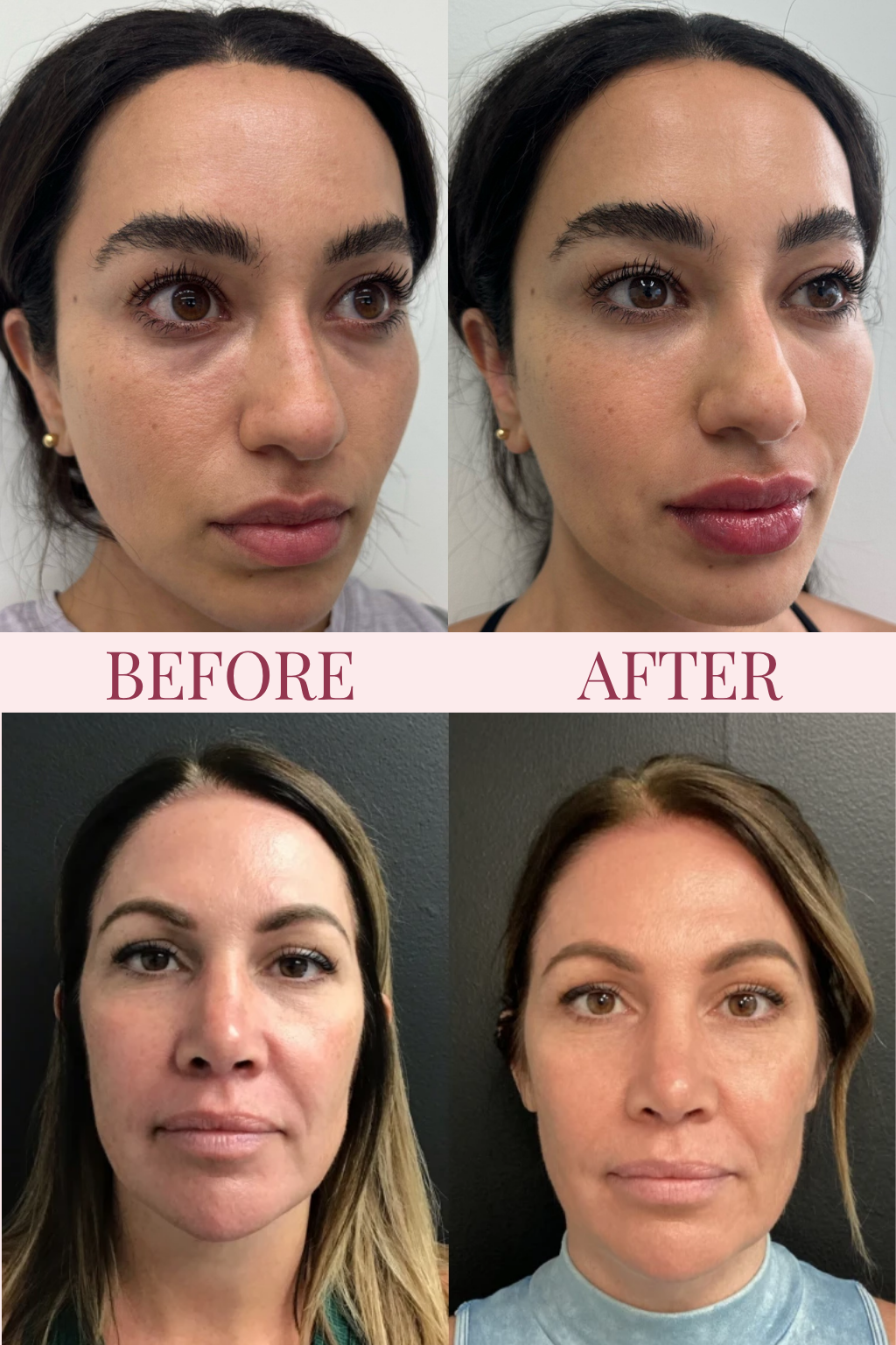 PDRN Pink Collagen Volume Multi Balm — Rebuild Volume. Smooth Lines. No Needles